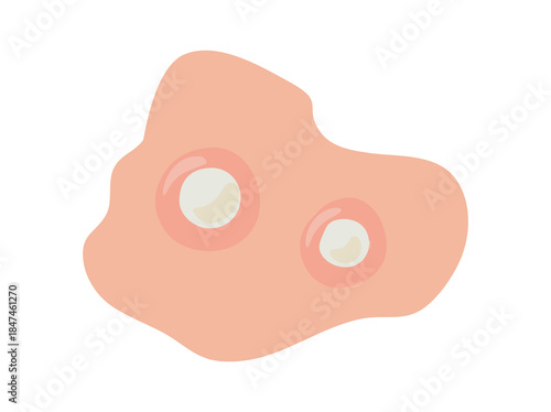 Acne Whitehead in Skin illustration