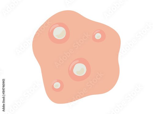 Acne Whitehead in Skin illustration