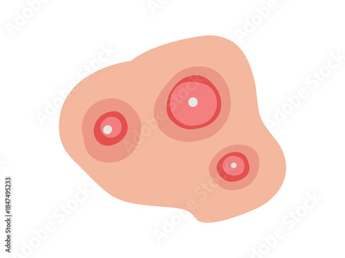 Acne Cystic in Skin