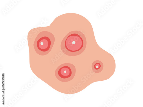 Acne Cystic Illustration
