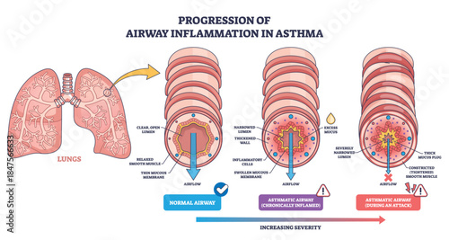 Airway inflammation progression in asthma shows normal to attack stages, with narrowing and mucus blocking airflow, lungs, bronchiole cross-sections, mucus plug. Outline diagram