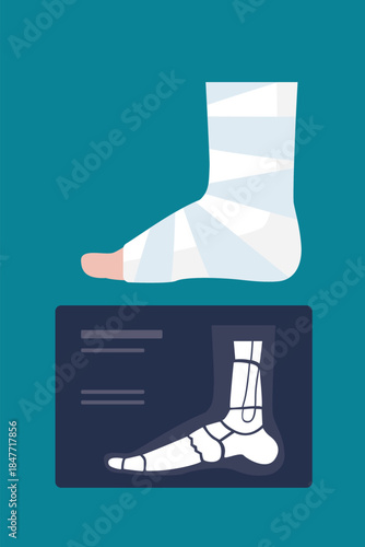 Leg injury treatment. Injured human foot with bandage, medical aid, x-ray. Medicine, health care, accident or trauma. Side view.