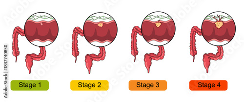 Illustration of colorectal cancer stages. Concept of colon cancer progression. Spread of tumor to lymph nodes. Medical vector illustration for clinics, education, and science