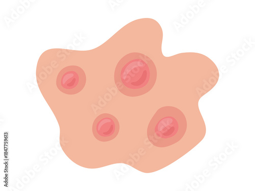 Acne Papule Clip Art Illustration

