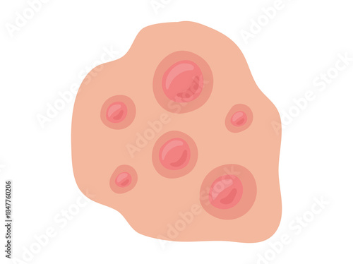 Acne Papule in Skin Clip Art