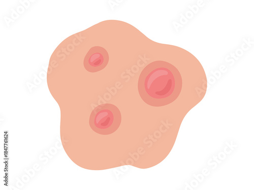 Acne Papule in Skin