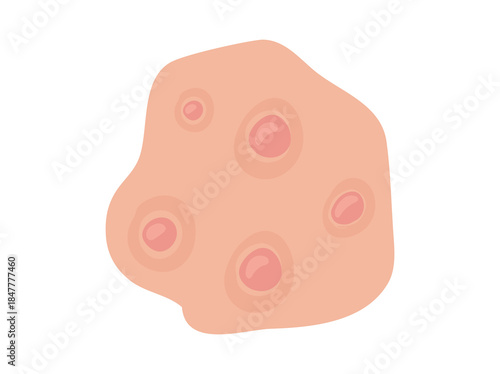 Acne Nodule Clip Art Illustration
