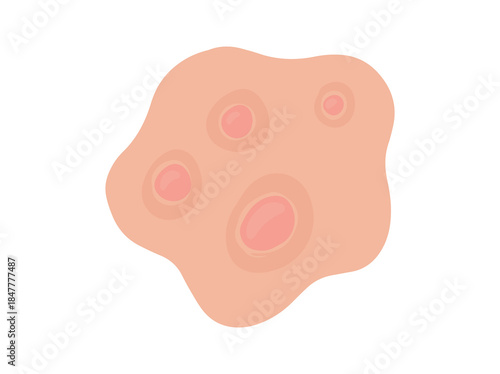Acne Nodule Clip Art Illustration
