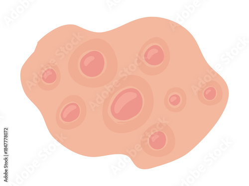 Hand Drawn Acne Nodule in Skin
