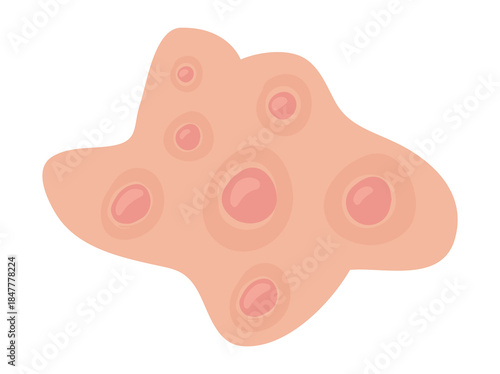 Hand Drawn Acne Nodule in Skin
