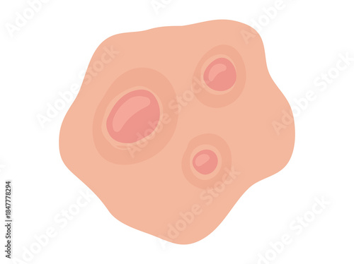 Acne Nodule in Skin Clip Art

