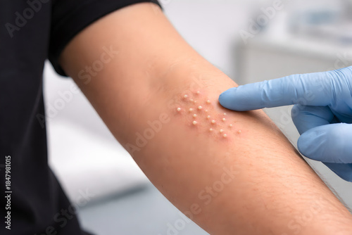 Photorealistic 3D depiction of mild pustular rash, close-up of upper arm skin showing multiple small raised pustules with pale centers and mild surrounding redness