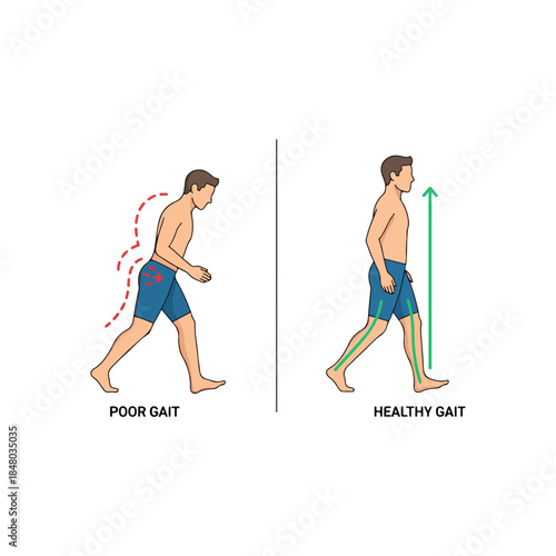 Comparison of Poor Gait and Healthy Gait in a Man.