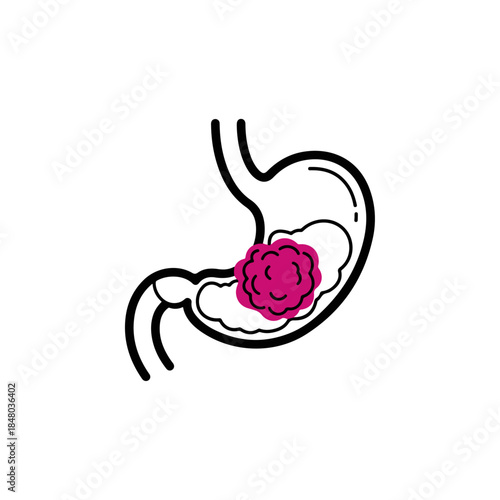 Stomach Anatomy Illustration with Ulcer Highlight.