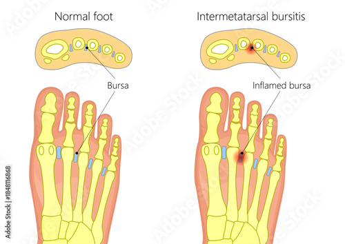 Normal foot and Intermetatarsal bursitis