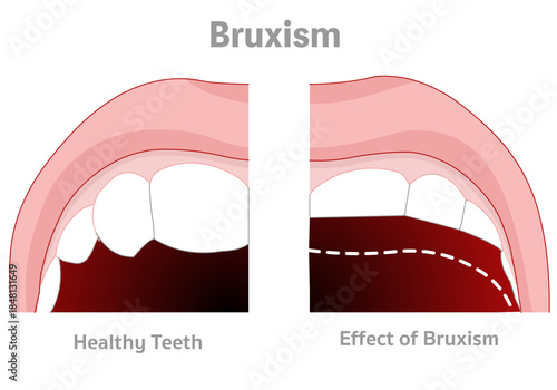 Bruxism is grinding or clenching your teeth too hard. Before normal and healthy teeth, After attrition teeth. Vector illustration