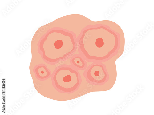 Acne Nodule Clip Art Illustration
