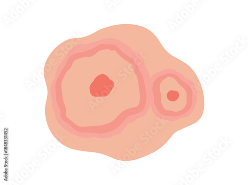 Erythema Migrans in Skin Illustration