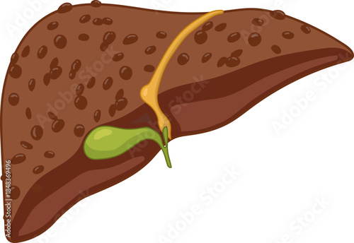 Anatomy of Cirrhosis