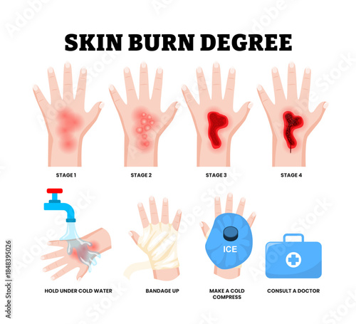 Stages of skin burn degree stages. First aid for burn wound. Fire damage to skin classification. Hand blisters. treatment for thermal wound with cold water, bandage, ice bag cold compress.