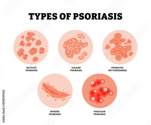 Different types of psoriasis skin derma disease. Labeled guttate, vulgar, inverse, pustular psoriasis and psoriatic erythroderma. Dermatology allergy, medical itch and rash, symptom of epidermis.