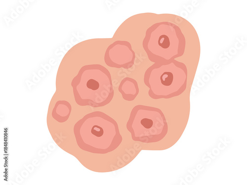 Erythema Multiforme Redness Clip Art
