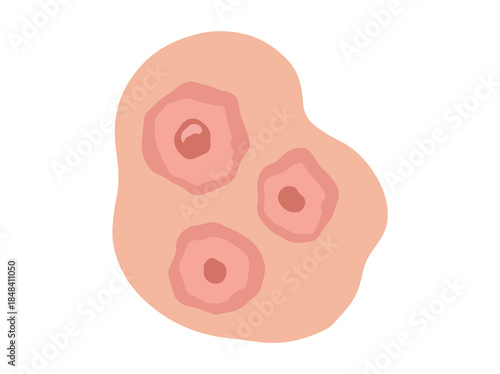 Hand Drawn Erythema Multiforme Redness
