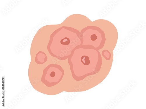 Erythema Multiforme in Skin Illustration
