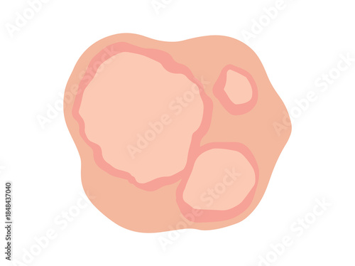 Hand Drawn Erythema Marginatum Redness
