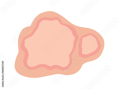Erythema Marginatum in Skin Illustration