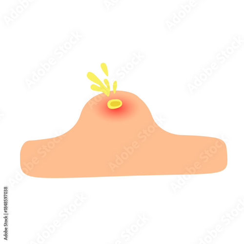 acne facial skin problem. anti acne skin care concept