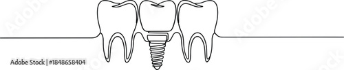 Dental implant procedure outline vector illustration showing tooth replacement with screw implant between natural teeth isolated on white background for dentistry and medical education