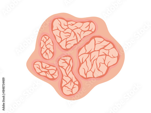 Scales or Psoriasis Scaly Plaques
