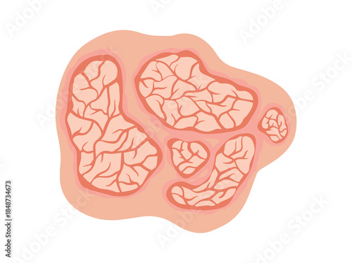 Scales Psoriasis Plaques Clip Art
