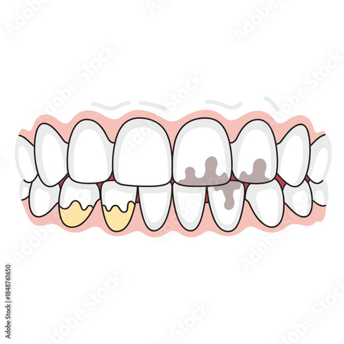 Illustration of teeth erosion and decay due to smoking habits  