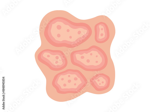 Hand Drawn Dermatophytosis Disease Illustration
