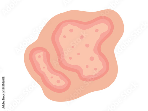 Hand Drawn Dermatophytosis Disease Illustration
