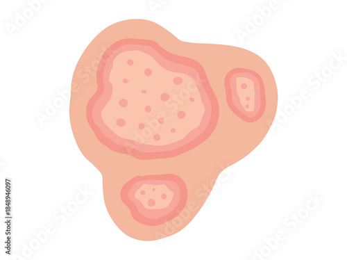 Hand Drawn Dermatophytosis or Dermatophytes
