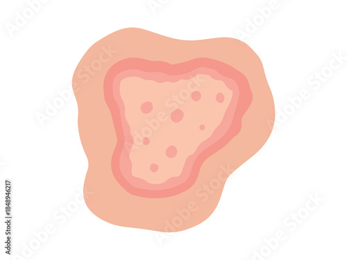 Hand Drawn Dermatophytosis or Dermatophytes
