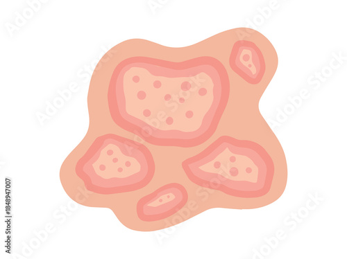 Dermatophytosis Disease Clip Art Illustration
