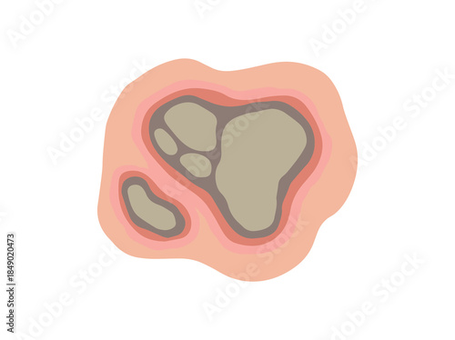 Necrosis Dead Tissue in Skin