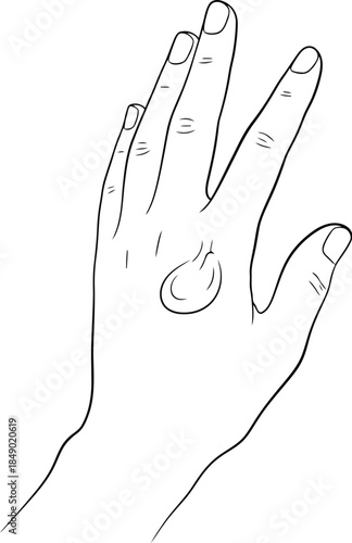 Hand illustration showing ganglion cyst on wrist in black and white outline