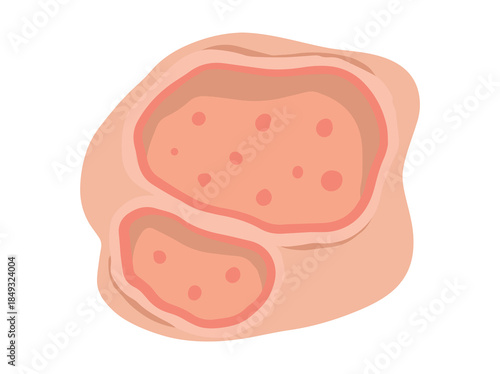 Ulcer Open Sore Clip Art
