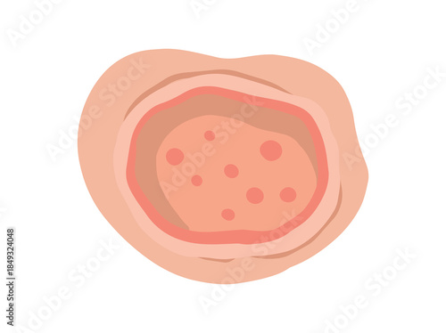 Ulcer Open Sore Clip Art
