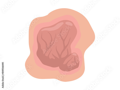 Hand Drawn Tumor Solid Mass
