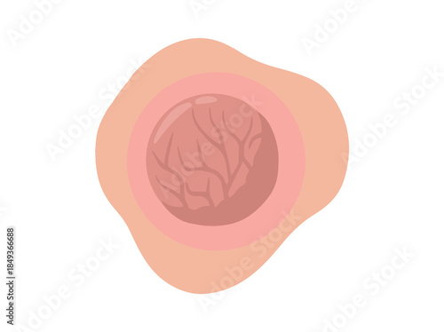 Tumor Solid Mass Clip Art
