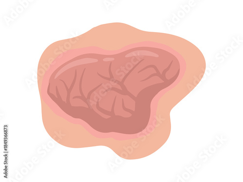 Tumor Solid Mass in Skin

