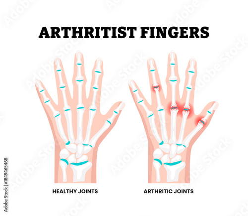 Healthy Joints and Arthritis Hand Disorder Symptoms Medical Illustration. Showing swollen finger joints and joint inflammation. Rheumatology. Inflammatory joint disease. Flat vector illustration