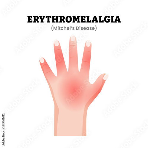Erythromelalgia Hand Disorder or Mitchel's Disease Symptoms Medical Illustration. Showing red painful skin with increased temperature. Dermatology. Rare vascular disorder. Flat vector illustration.