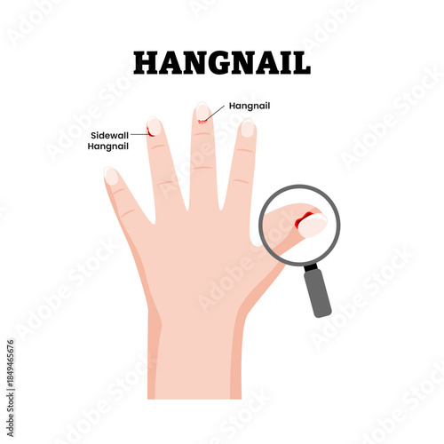 Hangnail Hand Condition Symptoms Medical Illustration. Showing torn skin near the fingernail. Sidewall Hangnail. Dermatology. Minor nail condition. Flat vector illustration.